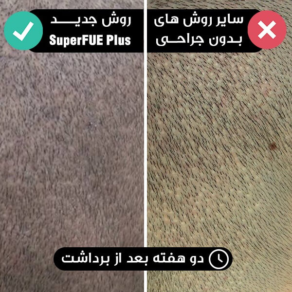 دو هفته بعد از برداشت مو