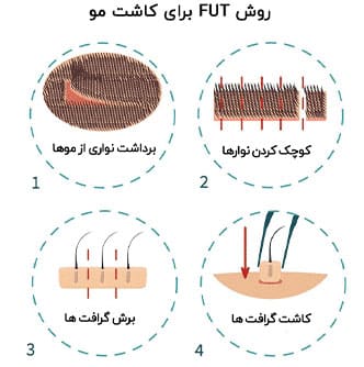 مراحل FUT برای کاشت مو