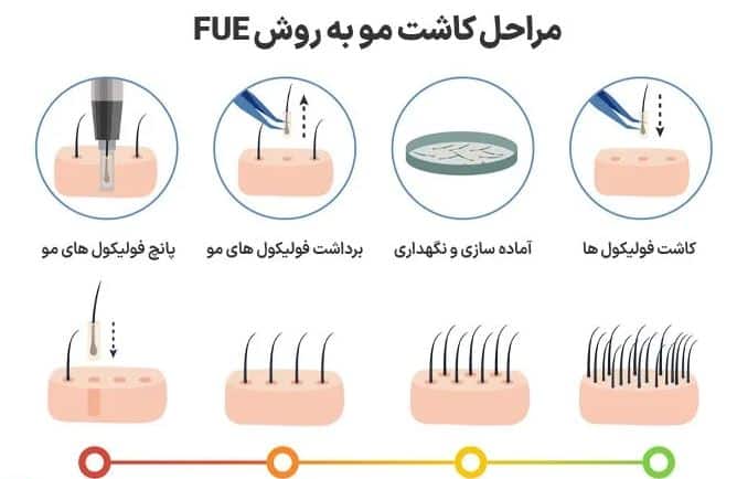 مراحل کاشت مو به روش FUE