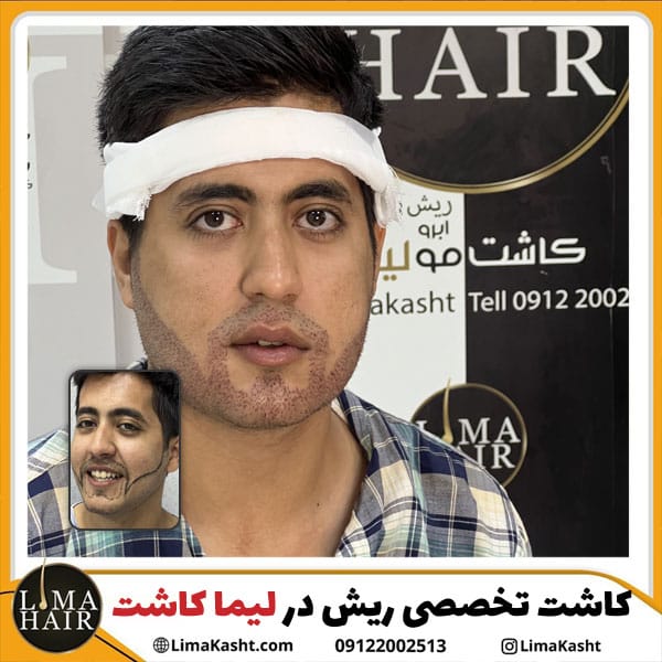 کاشت تخصصی ریش