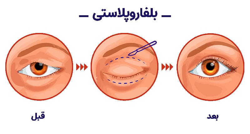 انجام فیلم عمل بلفاروپلاستی